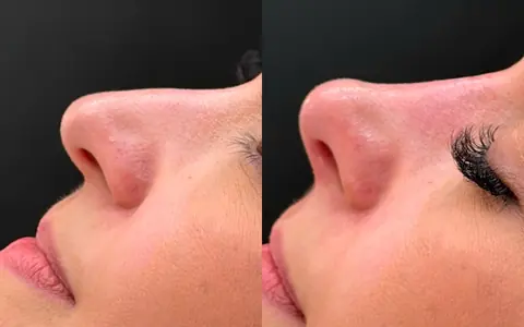 Antes e depois de perfil: nariz mais alinhado sem cirurgia