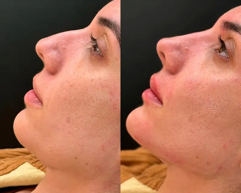Antes e depois de perfil: nariz e queixo mais alinhados