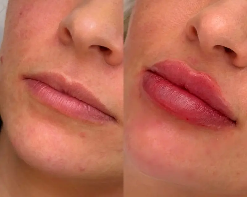 Antes e depois dos lábios de perfil: contorno mais definido
